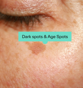 SIMPLE TRICK TO REMOVE BROWN SPOTS FROM YOUR SKIN
